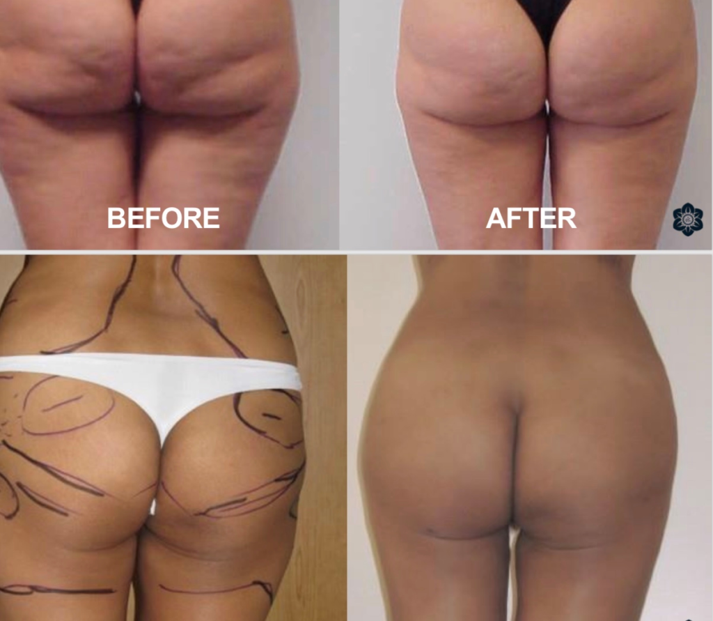 Finchley Cosmetic Clinic offers HYAcorp®️ MLF2 treatment
