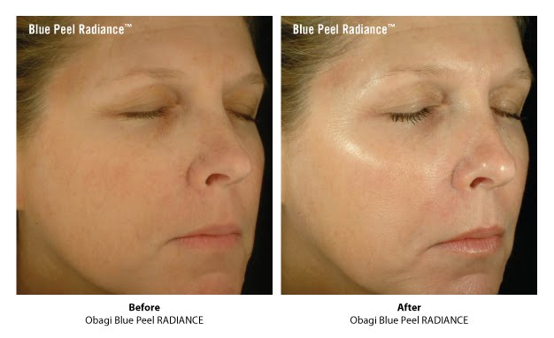 Obagi Blue Peel Radiance Before and After