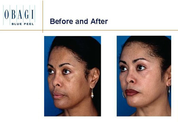 Chemical Peel London Obagi Blue Peel Before and After