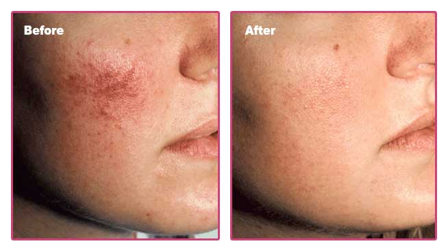 Thread vein treatment in London Before and After