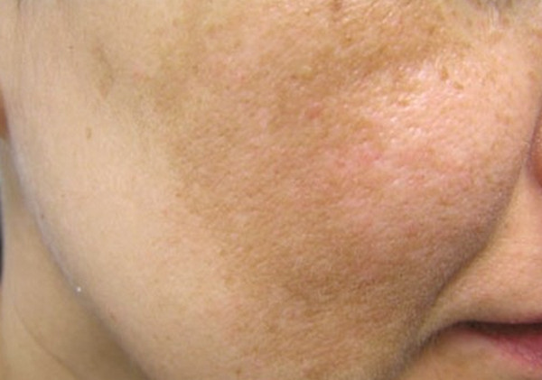 Pigmentation problems