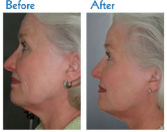 Skin Tightening Treatment Before and After