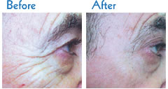 Before and after Skin Tightening treatment in London