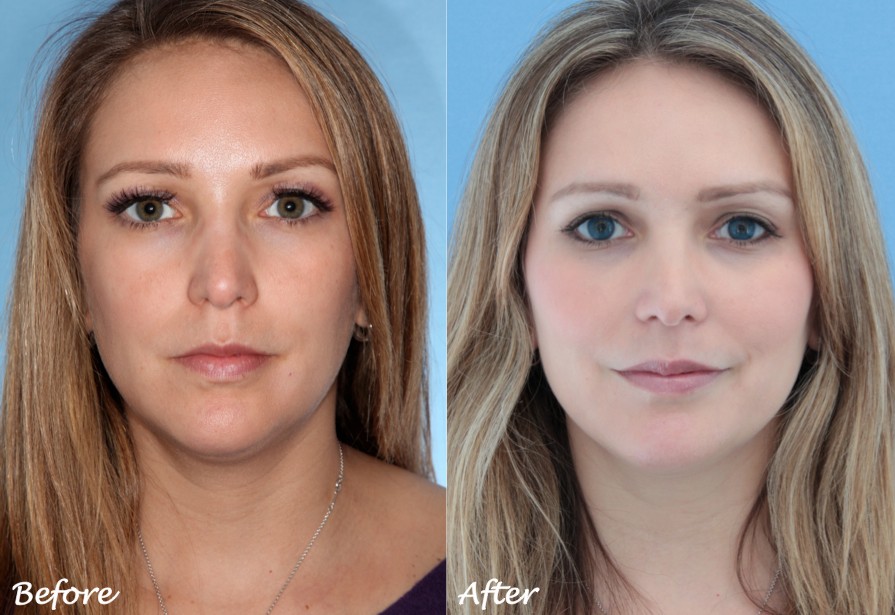 Sculptra Treatment London Before and After