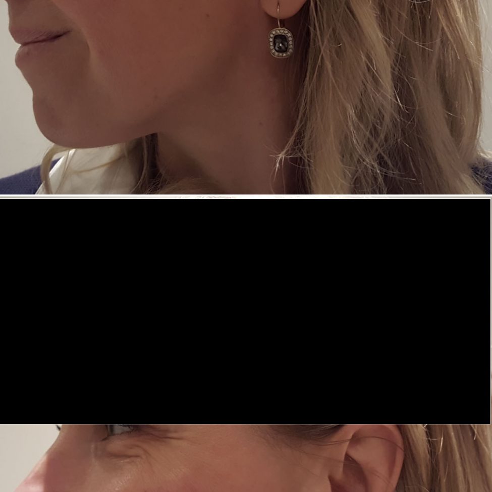 Anti-wrinkle injections treatment before and after