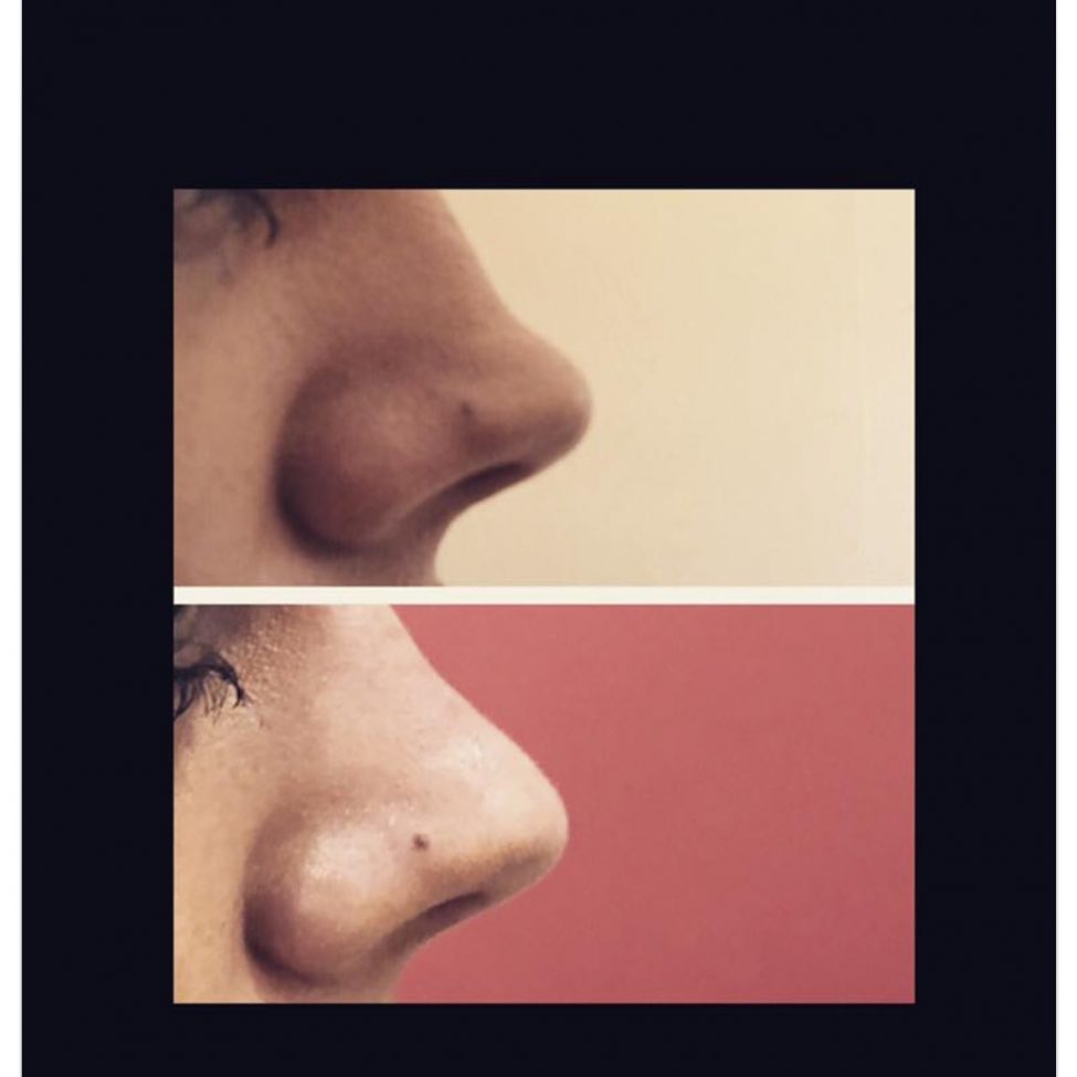 Finchley Cosmetic Clinic London treatment results