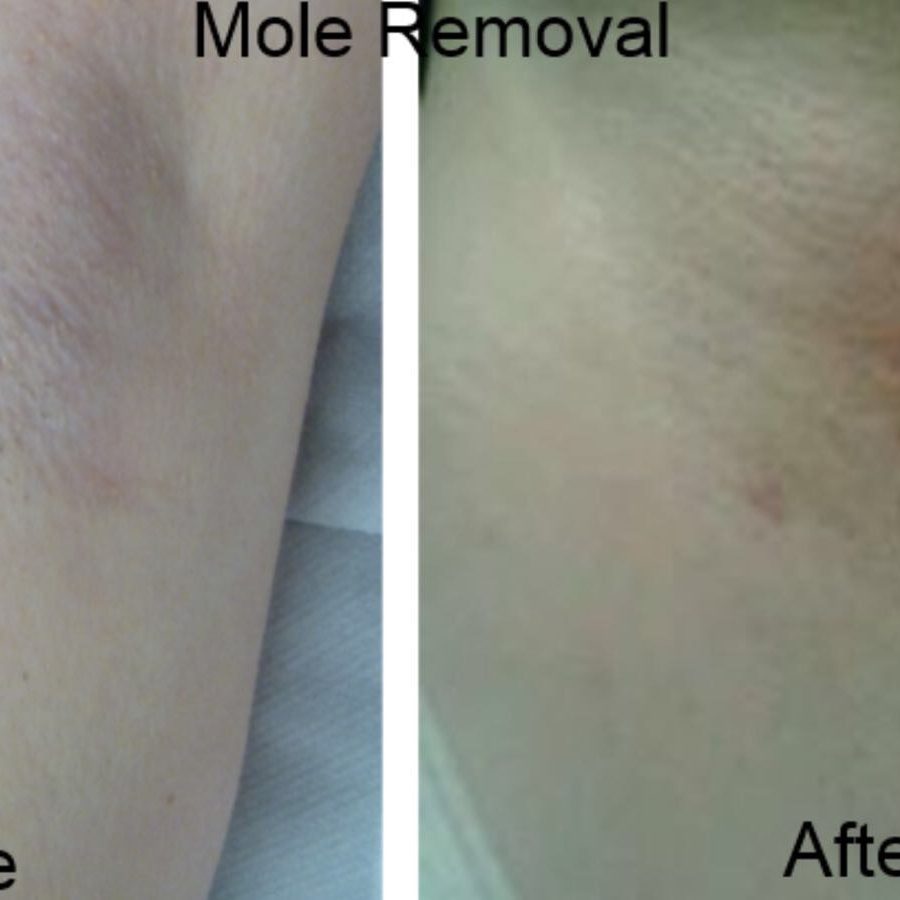 Mole removal treatment London Before and After