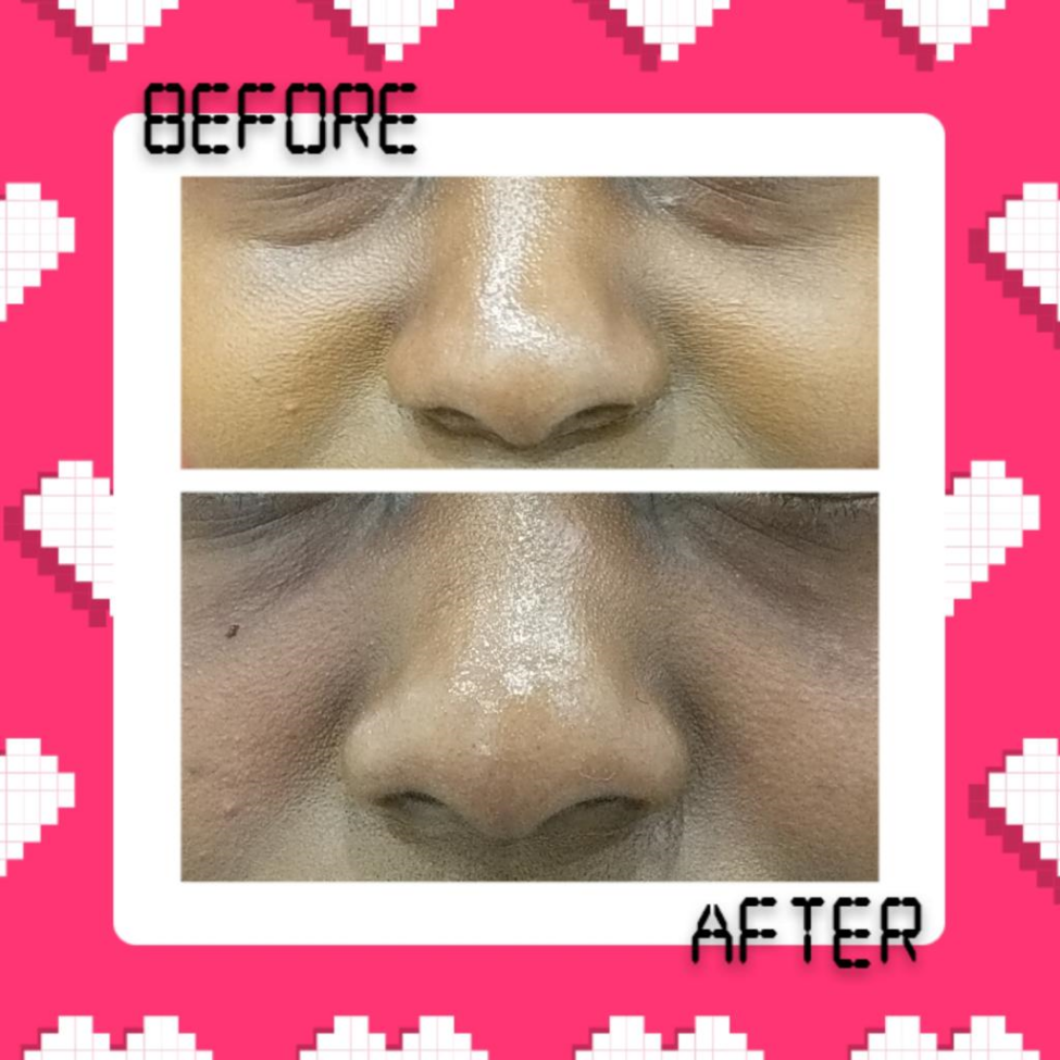 Nose augmentation Before and after