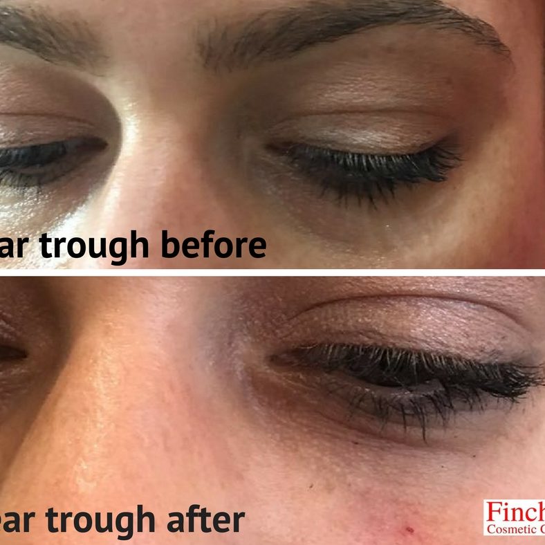 Tear trough treatment before and after