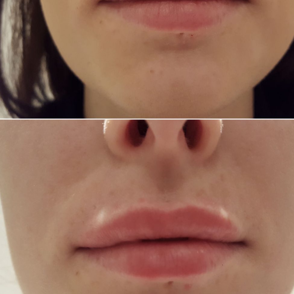 Lip fillers before and after