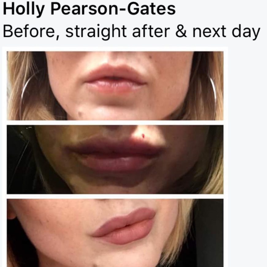 Lip fillers before and after