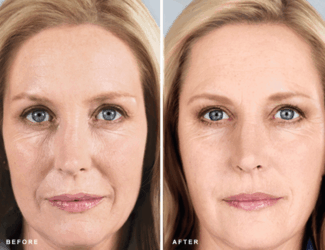 Sculptra treatment London Before and After