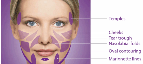 Sculptra Treatment