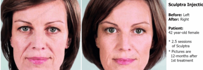 Sculptra Treatment