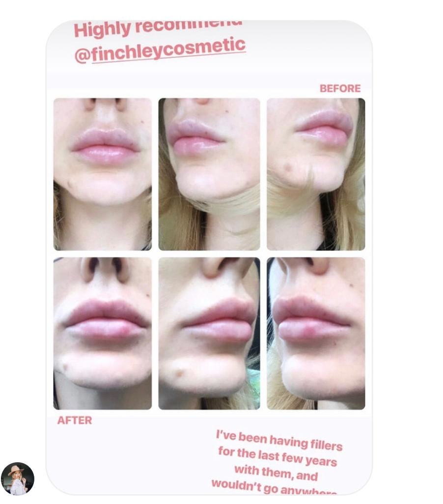 Lip Augmentation before and after