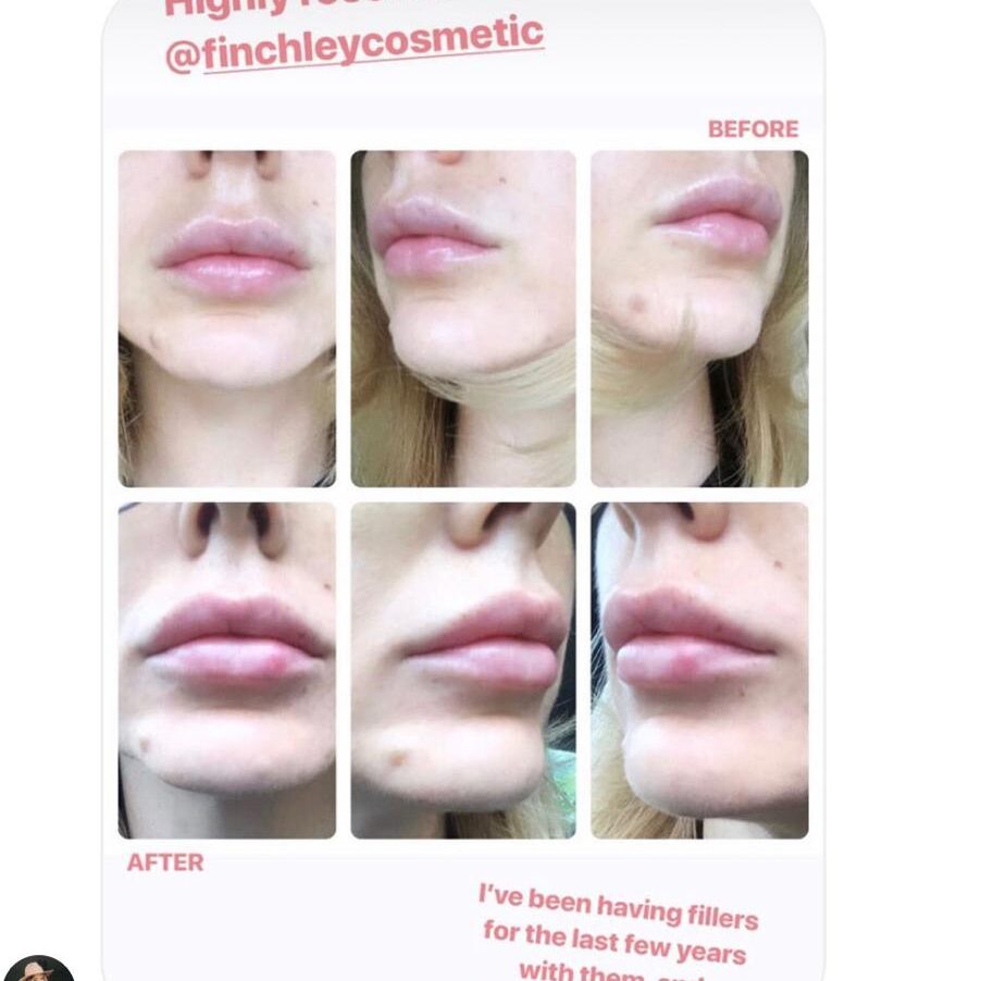 Lip fillers Before and After