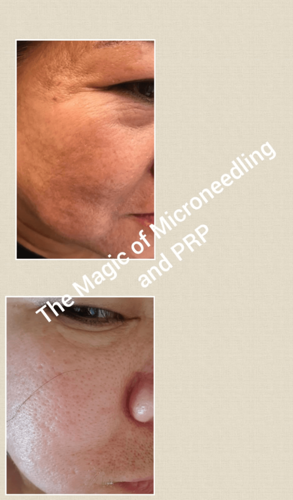 Platelet Rich Plasma Treatment
