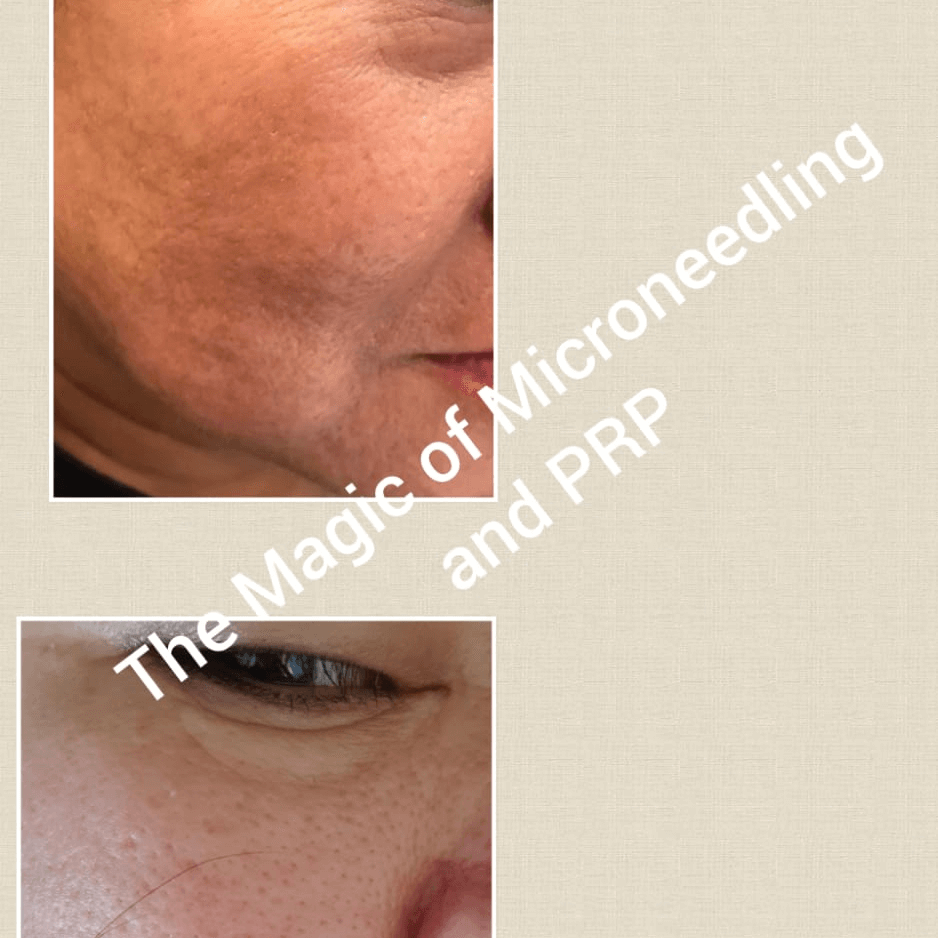 Platelet Rich Plasma Treatment