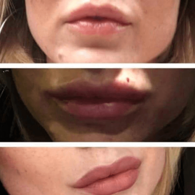 Lip augmentation London before and after