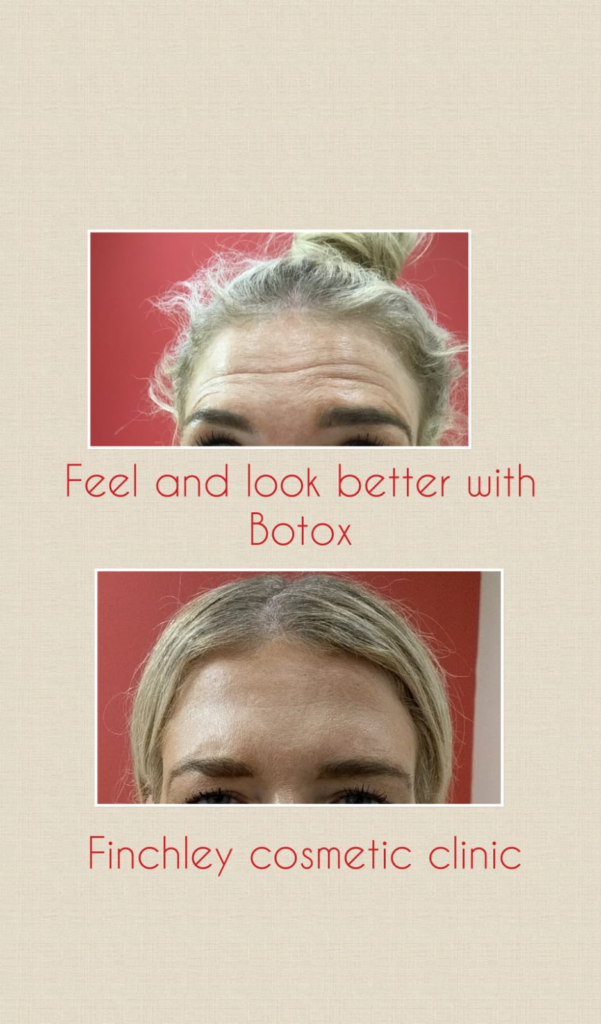 Botox in London before and after