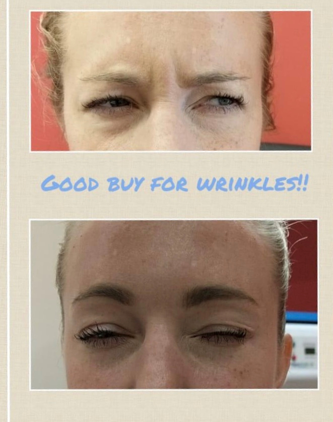 Botox in London before and after