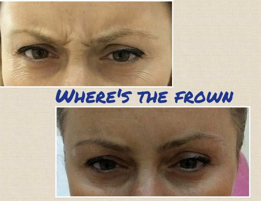 Botox in London before and after