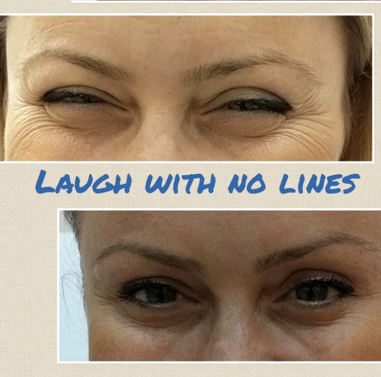 Botox in London before and after