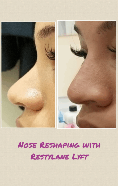Non-surgical rhinoplasty (Nose reshaping) with Restylane Before and After