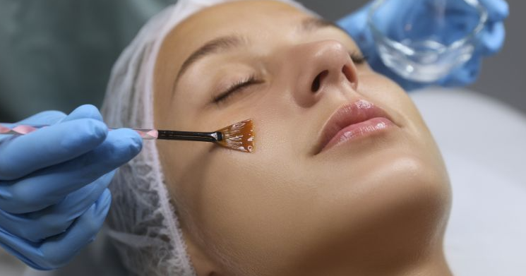 Chemical peel London