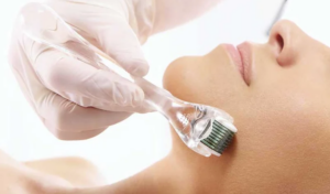 Dermaroller microneedling treatment London - acne and scarring treatment in London, North London, Finchley Cosmetic Salon