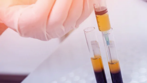 PRP in London - platelet rich plasma acne and scarring treatment in London, North London, Finchley Cosmetic Salon