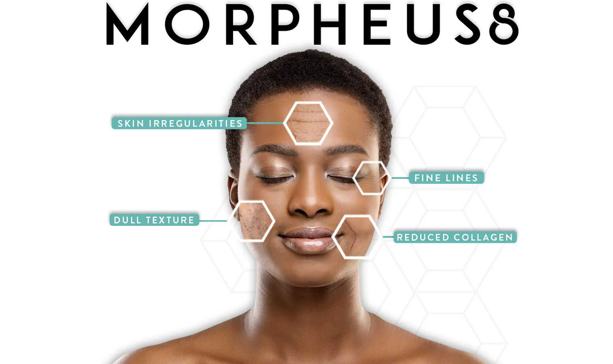 Morpheus8 in London, North London