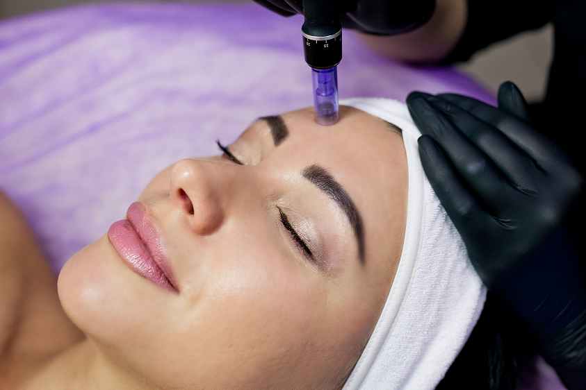 Microneedling / Dermaroller North London, London, Finchley