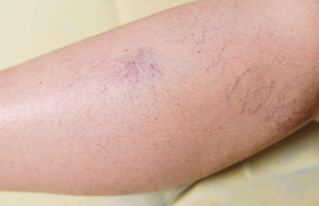 Thread Vein Treatments in London