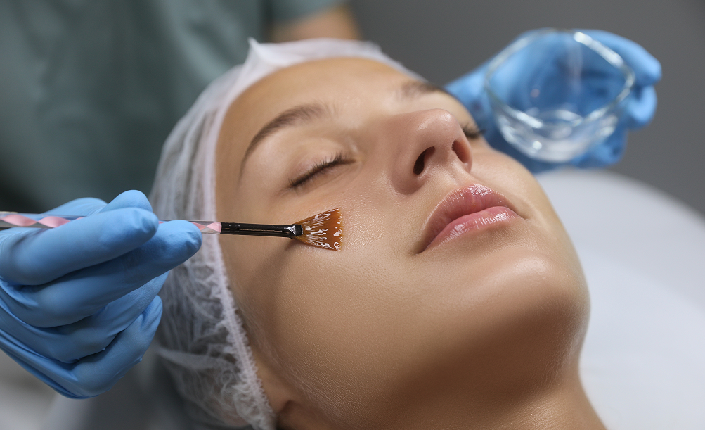 Chemical peels, North London, London, Finchley
