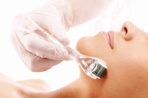 Dermaroller microneedling treatment London - acne and scarring treatment in London, North London, Finchley Cosmetic Salon