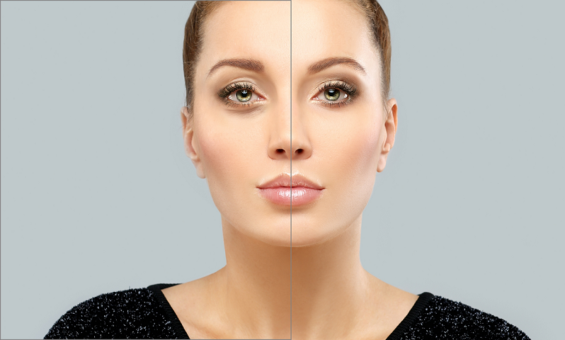 Tear Trough and Eye Bag Correction in London