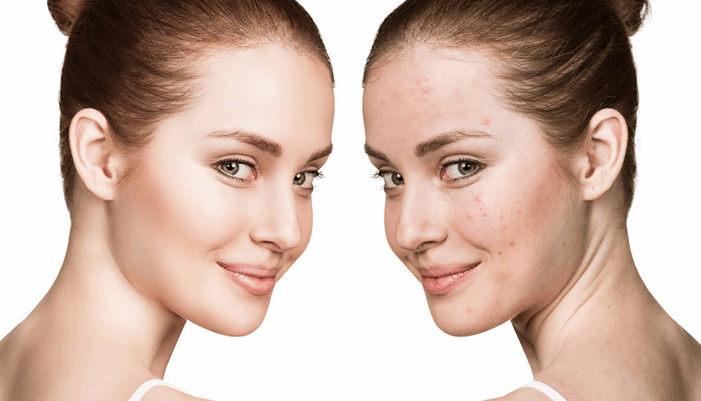 Acne and scarring treatment, London, North London, Finchley
