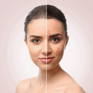 Acne and scarring treatment, London, North London, Finchley