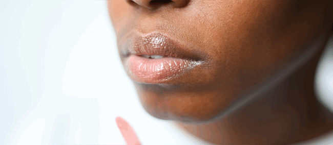 lip augmentation in London, North London
