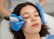 Chemical Peels vs Microneedling in London: Which Skin Treatment Gives Better Results?