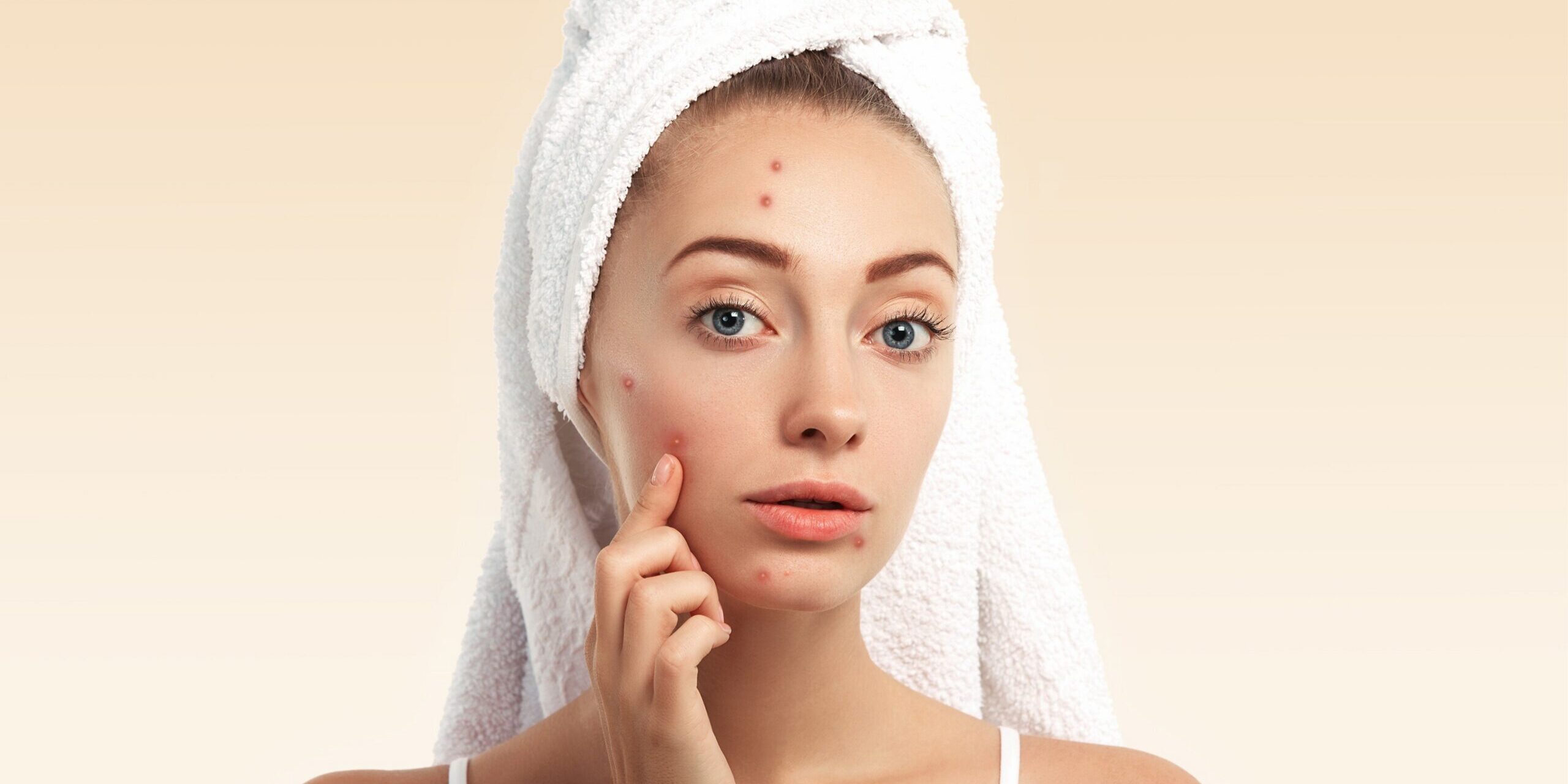 How to Choose the Right Acne Scar Treatment in London for Your Skin