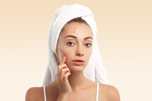 How to Choose the Right Acne Scar Treatment in London for Your Skin