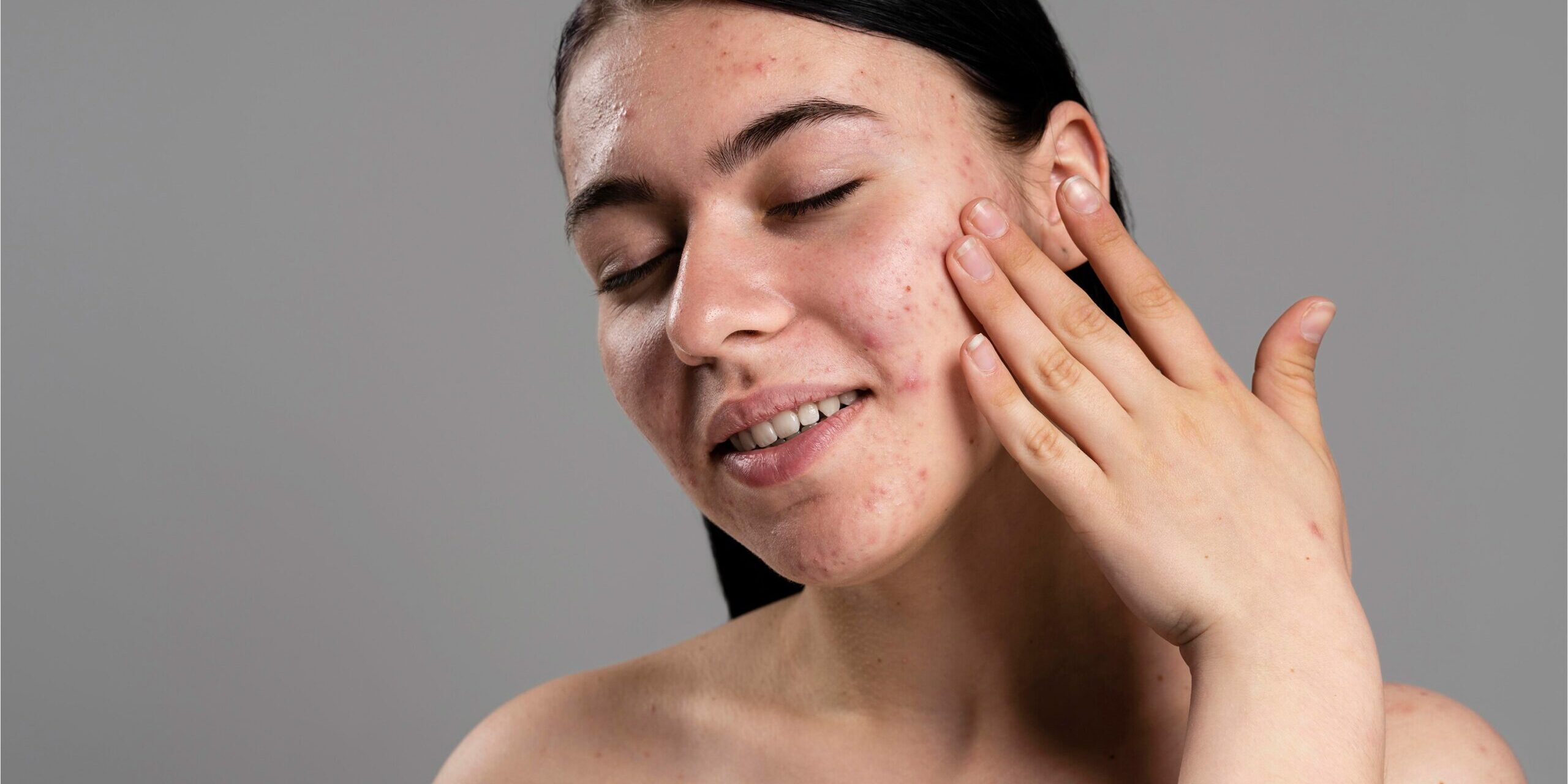 young-woman-showing-her-acne-with-confidence Best Treatments for Acne Scars in London: A Complete Guide