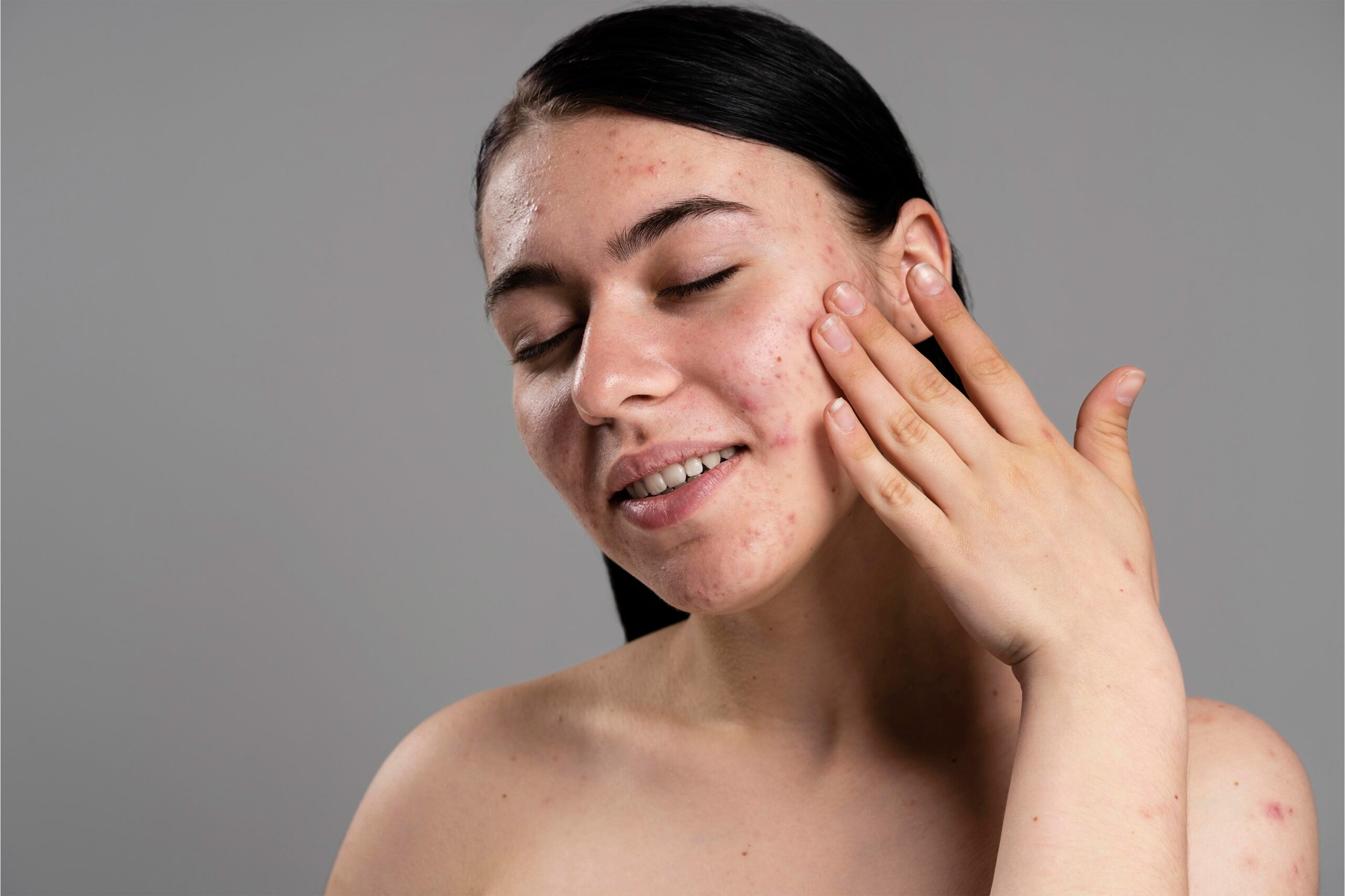 young-woman-showing-her-acne-with-confidence Best Treatments for Acne Scars in London: A Complete Guide
